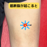 マジックジャンパーテーピング